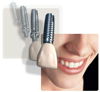 انواع بی دندانی و طرح درمان آنها توسط ایمپلنت