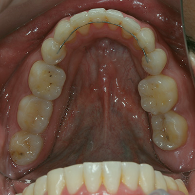 اسپیلینت دندان